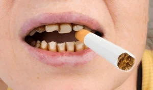 سیگار برای ارتودنسی ضرر دارد