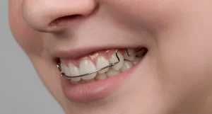 سن ارتودنسی متحرک