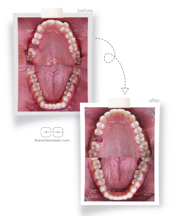 نمونه درمان ارتودنسی ثابت دکتر یلدا پرنمازه 001 (1)