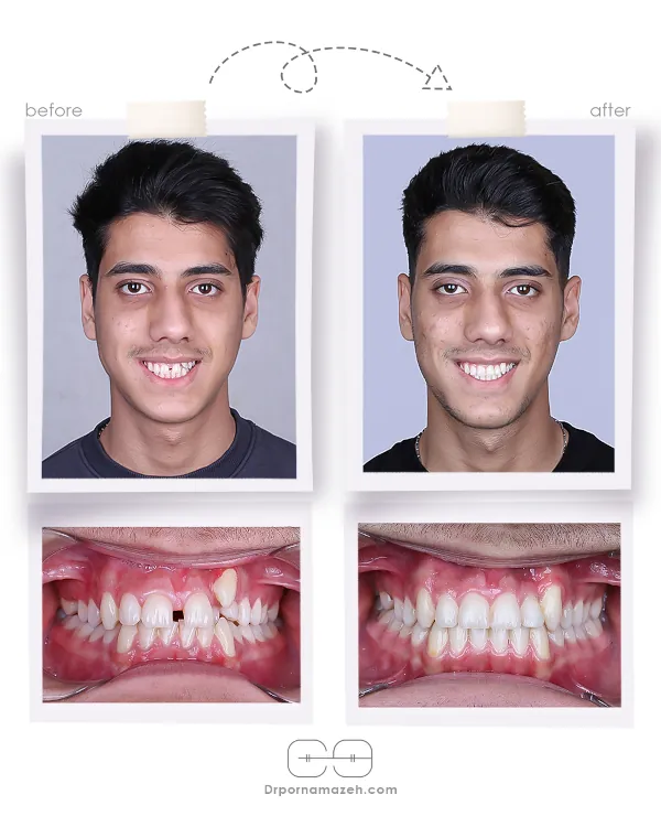 نمونه درمان ارتودنسی ثابت دکتر یلدا پرنمازه 001 (2)