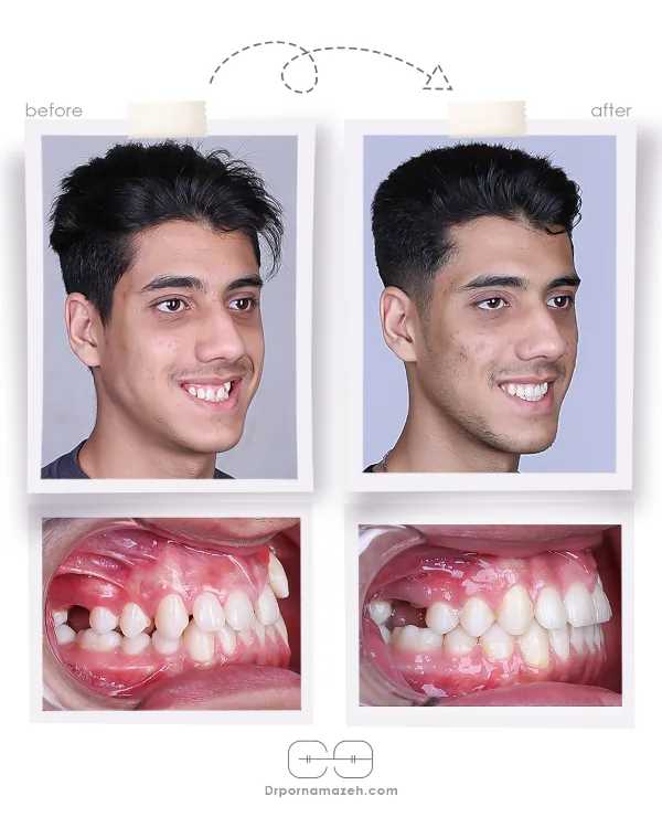 نمونه درمان ارتودنسی ثابت دکتر یلدا پرنمازه 001 (3)