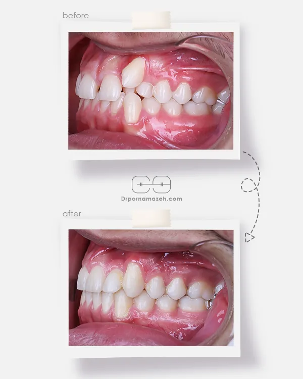 نمونه درمان ارتودنسی ثابت دکتر یلدا پرنمازه 001 (4)