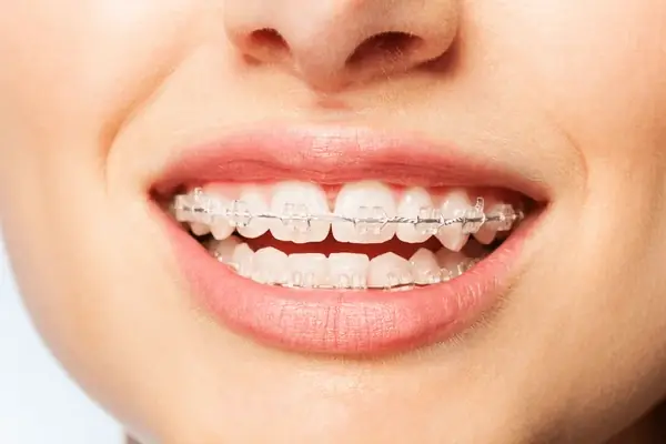 ویژگی های ارتودنسی سرامیکی